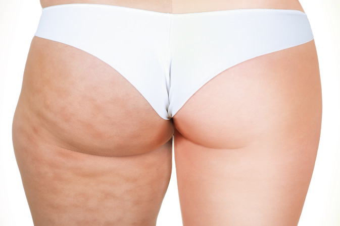 pressoterapia e cellulite